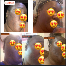 Load image into Gallery viewer, Good bye Acne Hello Glow