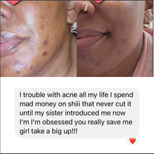 Load image into Gallery viewer, Good bye Acne Hello Glow