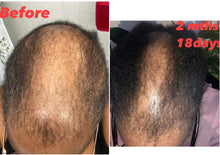 Load image into Gallery viewer, Alopecia Bundle