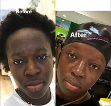 Load image into Gallery viewer, Good bye Acne Hello Glow