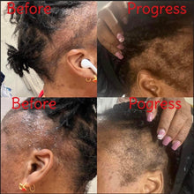 Load image into Gallery viewer, Alopecia Bundle