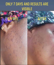 Load image into Gallery viewer, Healing Acne Mask