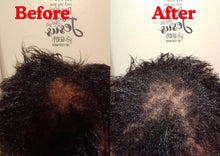 Load image into Gallery viewer, Alopecia Bundle