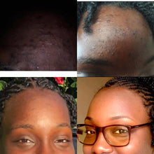 Load image into Gallery viewer, Healing Acne Mask