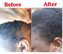 Load image into Gallery viewer, Alopecia Bundle