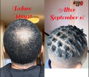 Alopecia Package
