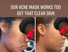Load image into Gallery viewer, Healing Acne Mask
