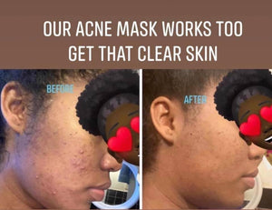 Healing Acne Mask