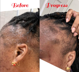 Alopecia Package